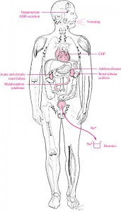 Hyponatremia-3