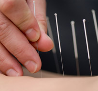 ACUPUNCTURE